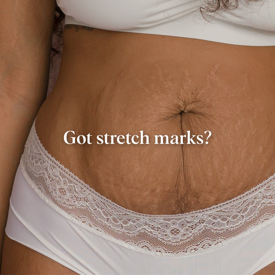 Stretch Marks, Five Things You Didn’t Know